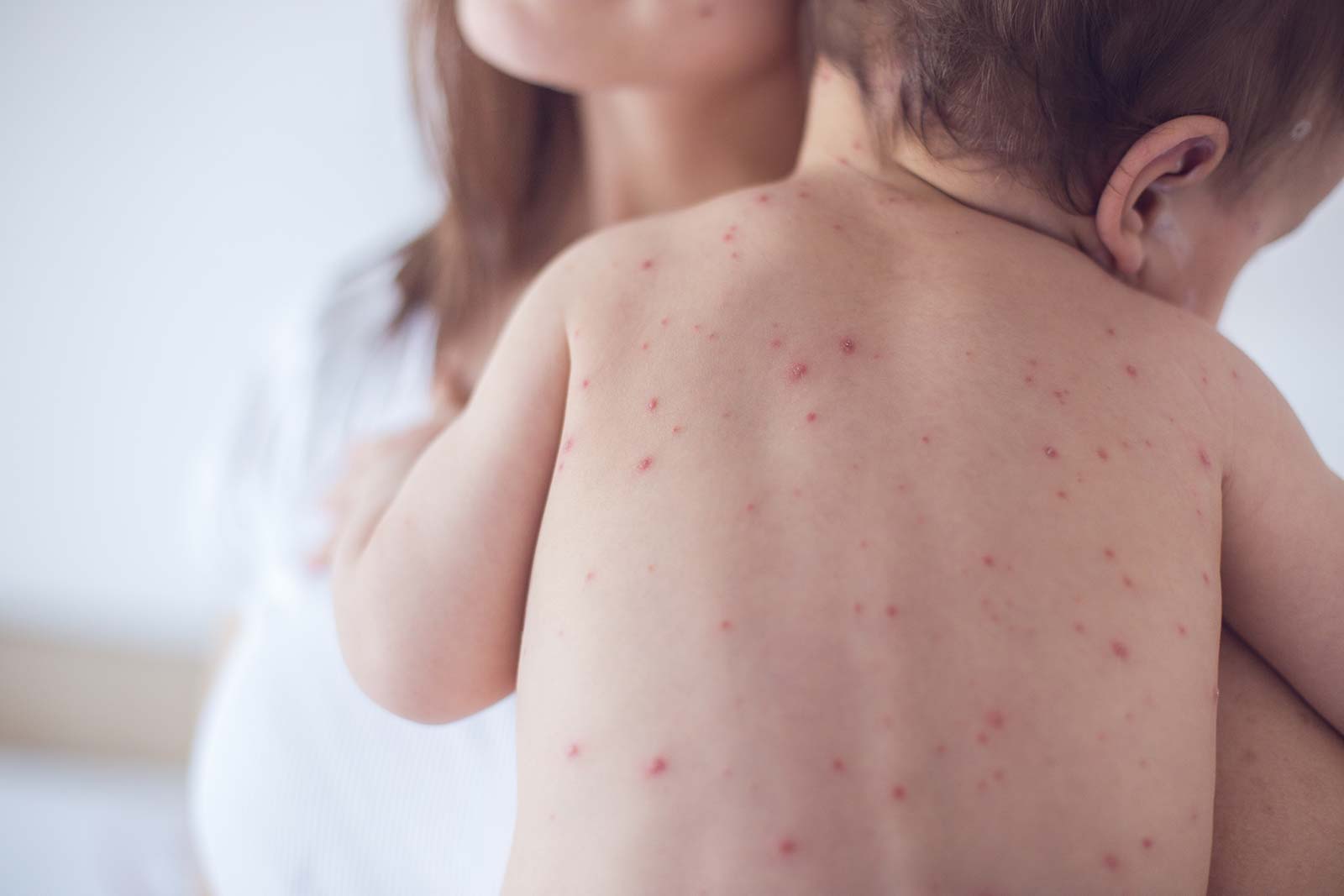 Medinz Keeps Auckland safe in a measles outbreak